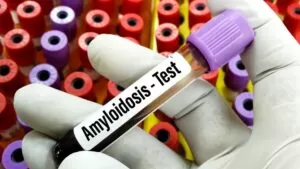 Amiloidosis por transtiretina una enfermedad hereditaria que afecta el sistema nervioso y cardíaco