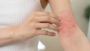FDA aprueba la crema de roflumilast al 0,15% para el eczema en pacientes desde los 6 años 10 FDA aprueba la crema de roflumilast al 0,15% para el eczema en pacientes desde los 6 años