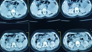 Proteína RUVBL1: Clave para nuevos tratamientos contra el cáncer de páncreas