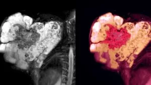 Tecelra: la revolución en terapias celulares para el sarcoma sinovial aprobada por la FDA 4 Tecelra: la revolución en terapias celulares para el sarcoma sinovial aprobada por la FDA
