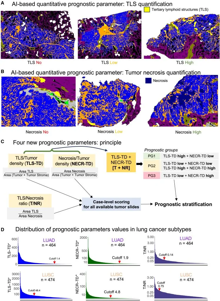 AI cancer de pulmon analisis