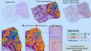 IA revoluciona el diagnóstico de cáncer de pulmón