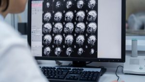 Philips y Medtronic se unen para mejorar el acceso al tratamiento del ictus (ACV) 10 Philips y Medtronic se unen para mejorar el acceso al tratamiento del ictus (ACV)