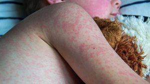 Alerta epidemiológica por brote de sarampión en las Américas: OPS