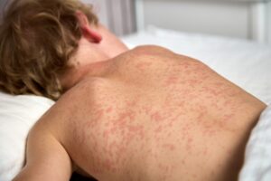 Incremento de sarampión en el mundo: OMS reporta 10,3 millones de infectados en 2023 26 sarampión